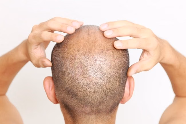 Bahan Alami Penumbuh Rambut Kembali Populer, Jadi Alternatif Perawatan yang Lebih Aman